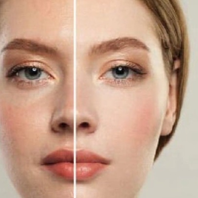 Tratamiento de Ojeras, Dra. Gloria Vitriol